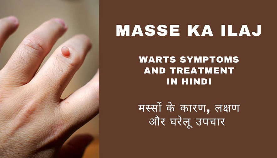 Masse ka Ilaj - Warts Symptoms and Treatment in Hindi - मस्सों के कारण, लक्षण और घरेलू उपचार